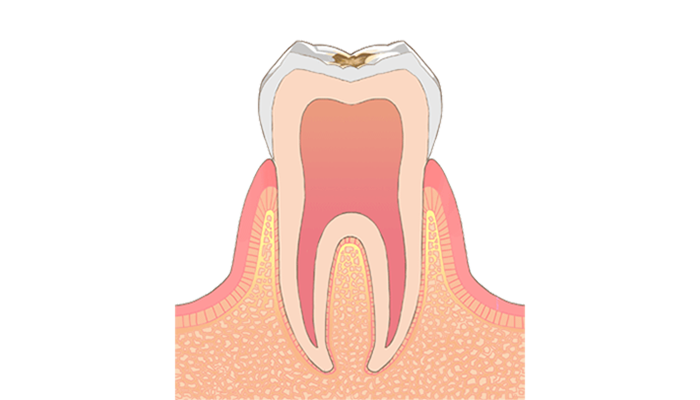 C1：歯の表面（エナメル質内）の虫歯