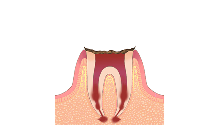 C4：歯の根元のみ残っている虫歯