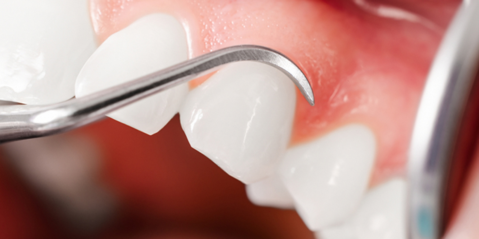 虫歯の原因と予防ケアの重要性について