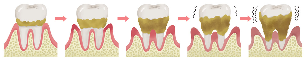 歯周病（歯槽膿漏）チェックリスト