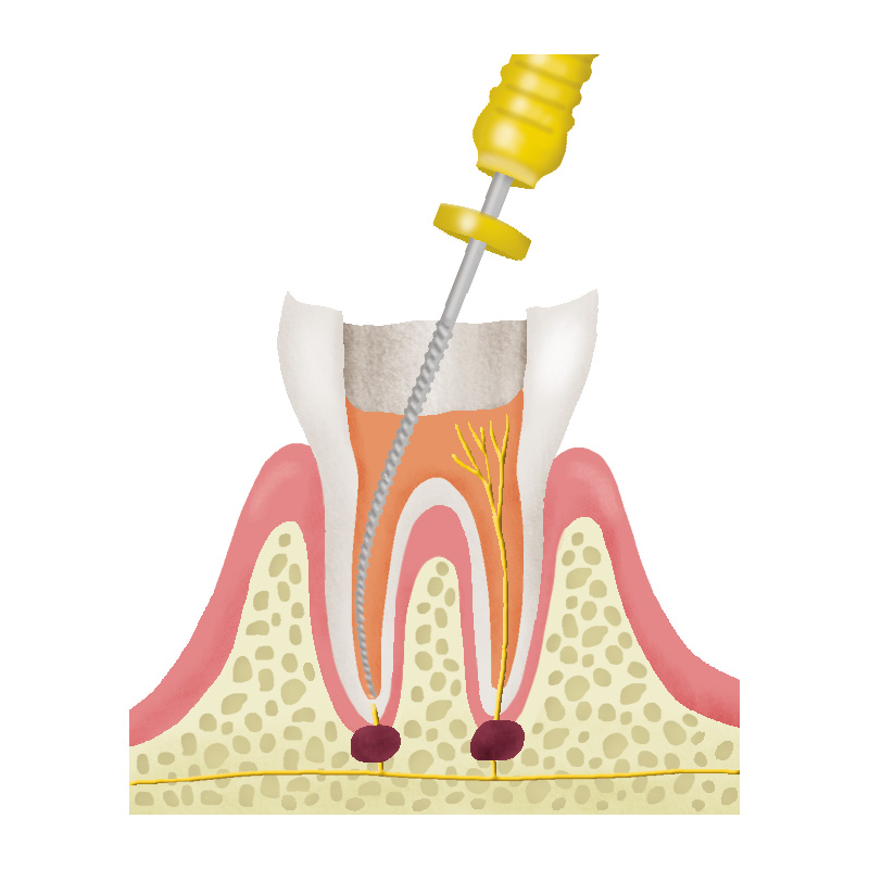 根管治療の流れについて