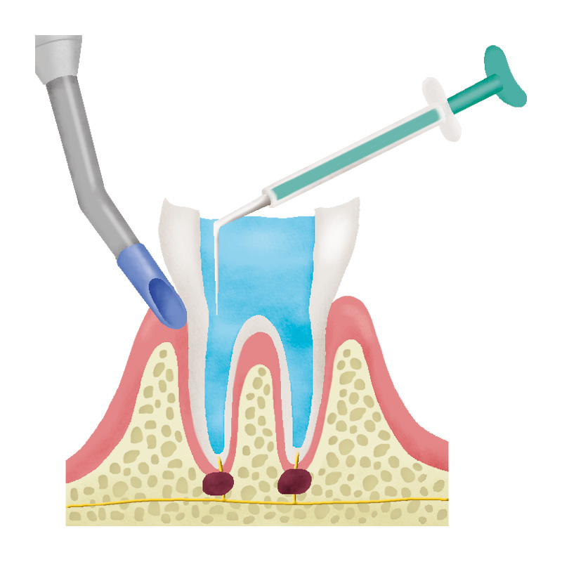 根管治療の流れについて