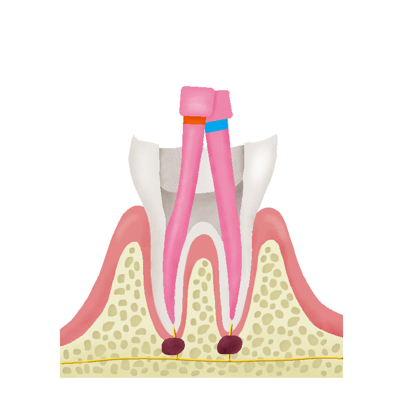 根管治療の流れについて