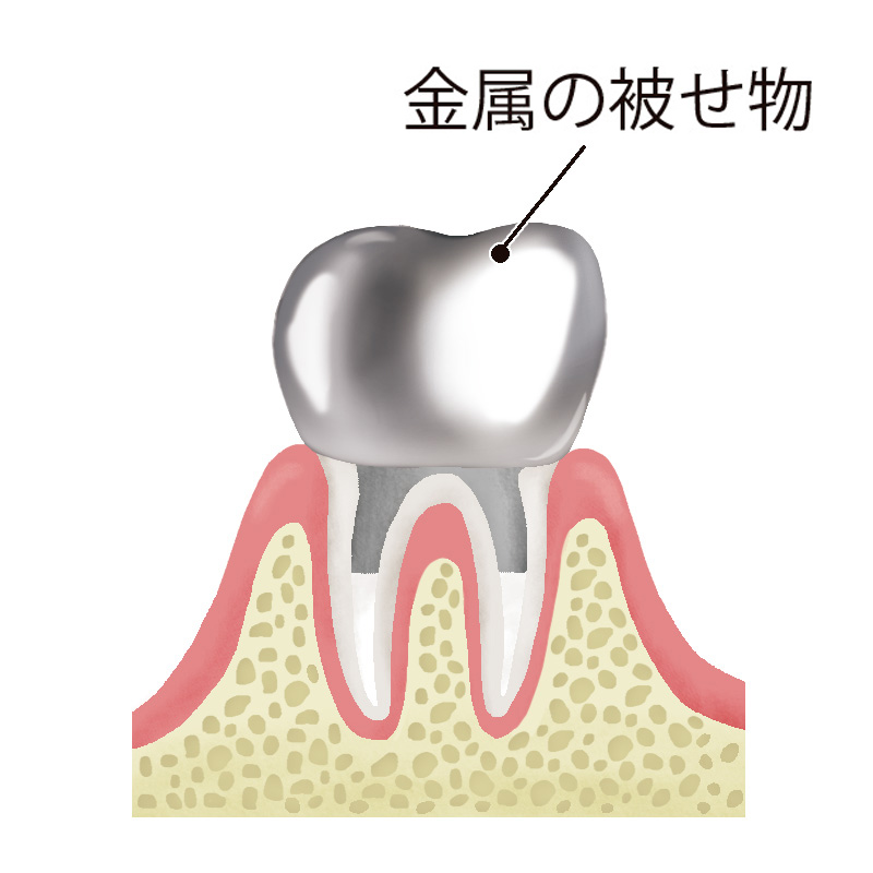 根管治療の流れについて