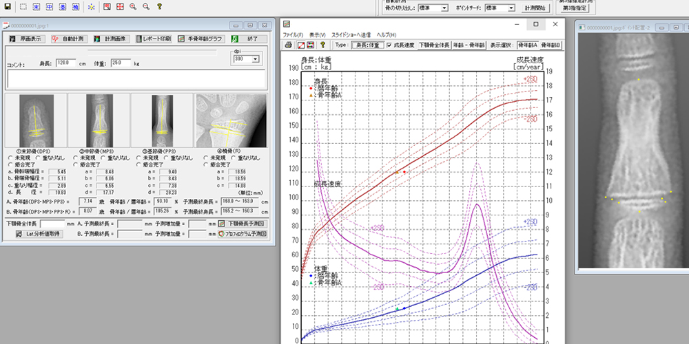 手の骨年齢から「身長の予測分析」ができます